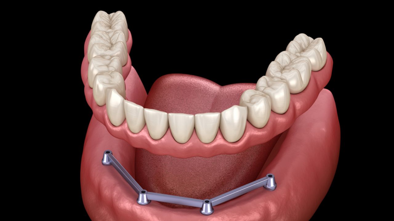 Prótese Ortoshine Consultório Odontológico